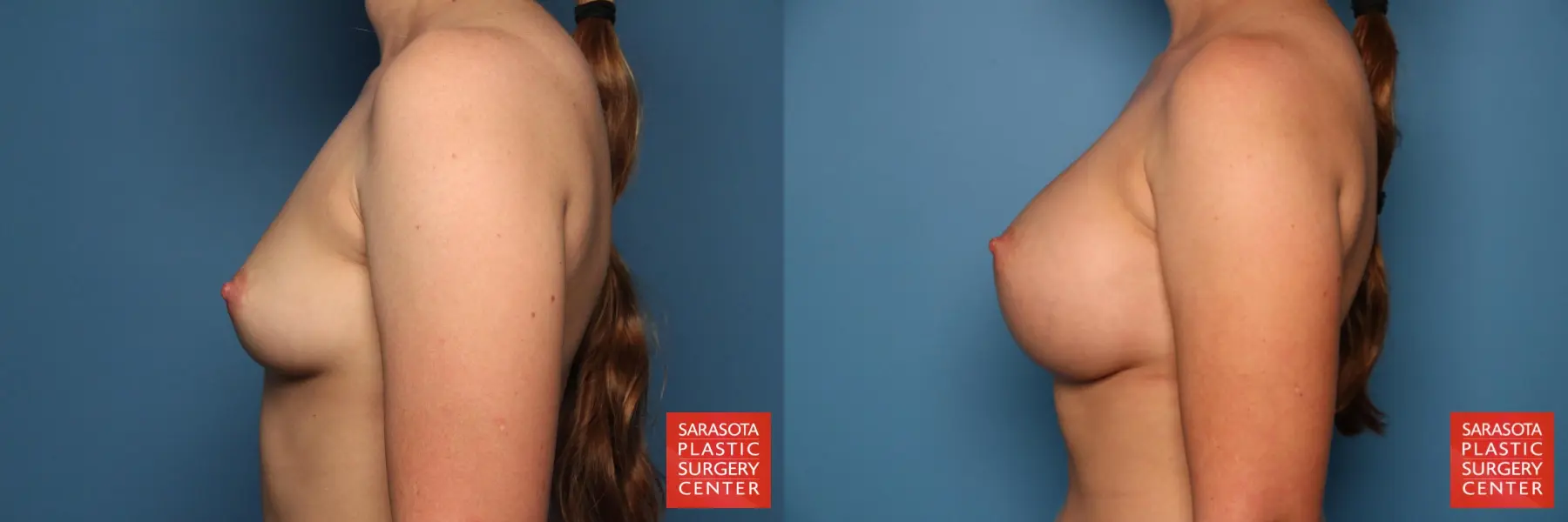 Breast Augmentation: Patient 46 - Before and After 3