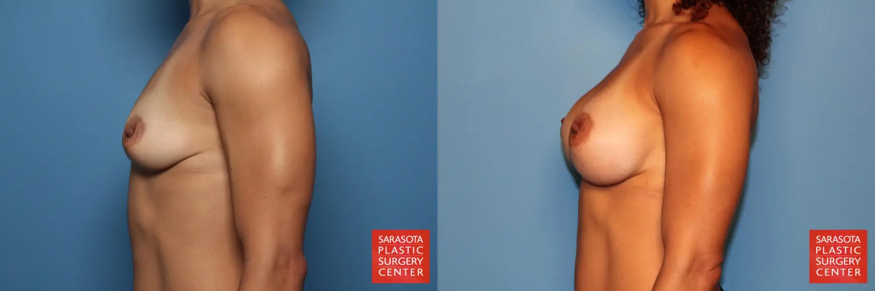 Breast Augmentation: Patient 79 - Before and After 3