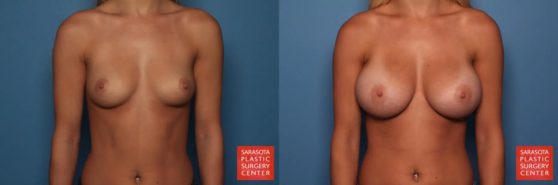 Breast Augmentation: Patient 9 - Before and After 1