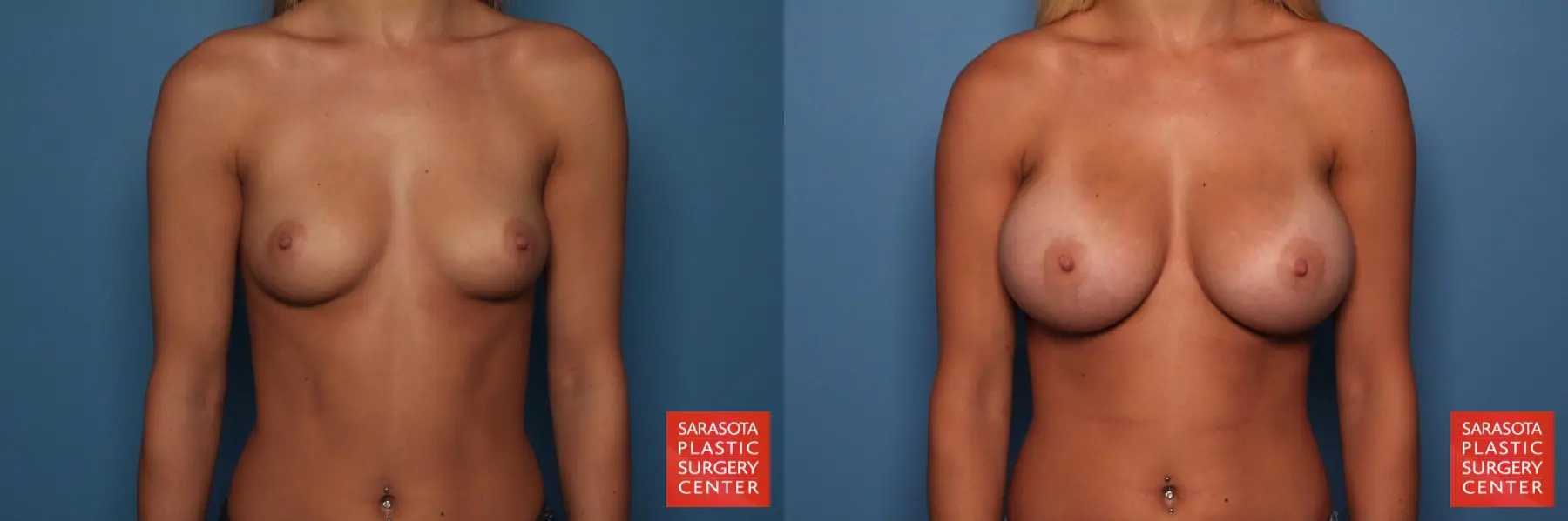 Breast Augmentation: Patient 9 - Before and After  