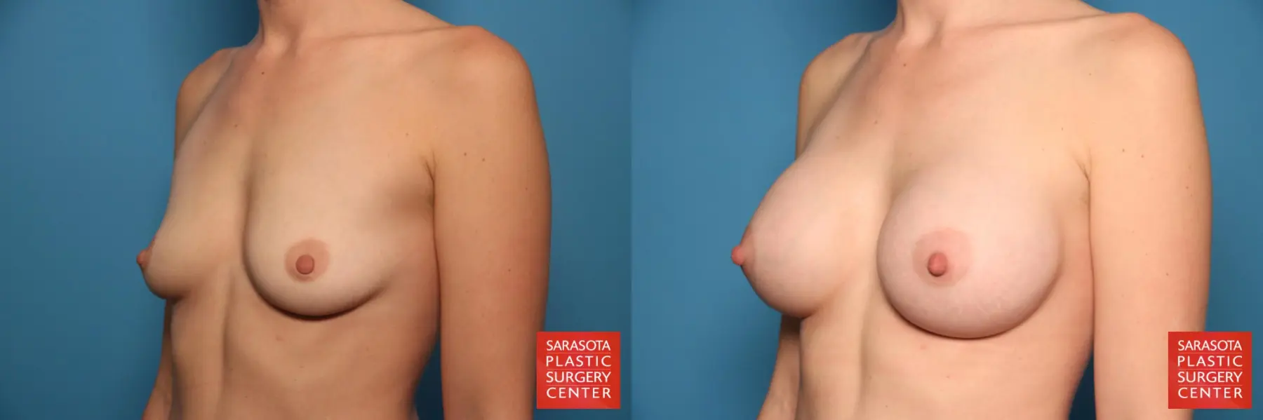 Breast Augmentation: Patient 162 - Before and After 2