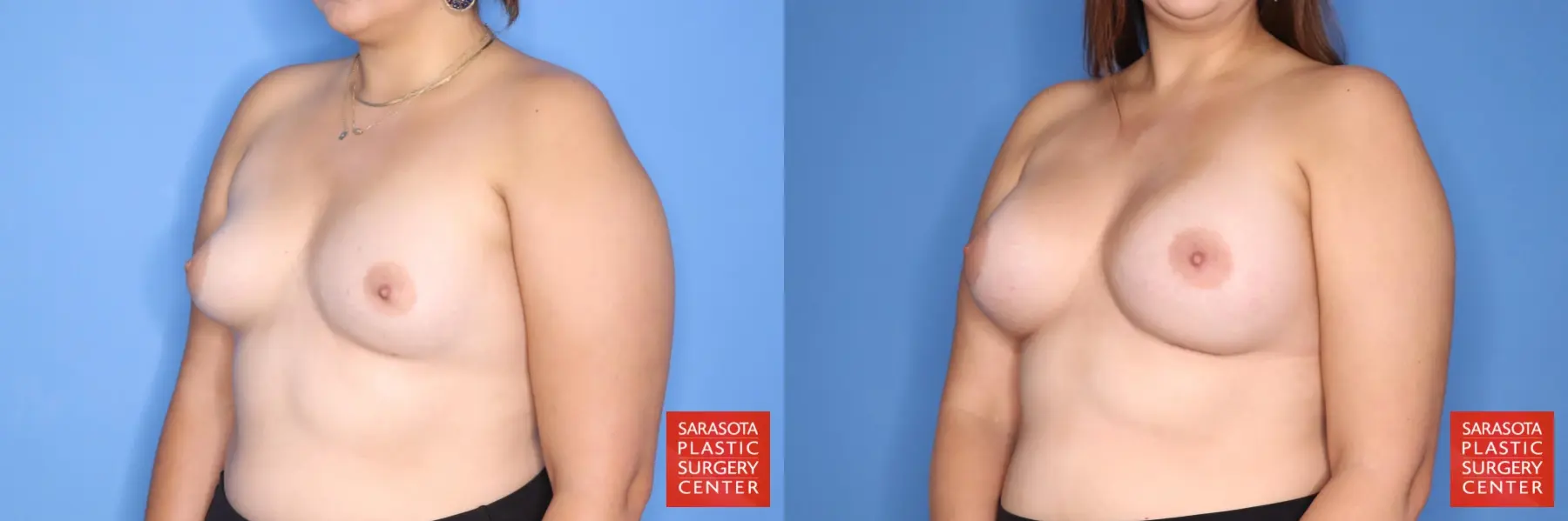 Breast Augmentation: Patient 200 - Before and After 2