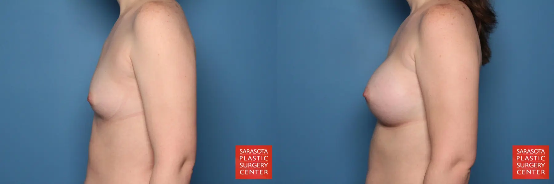 Breast Augmentation: Patient 118 - Before and After 3