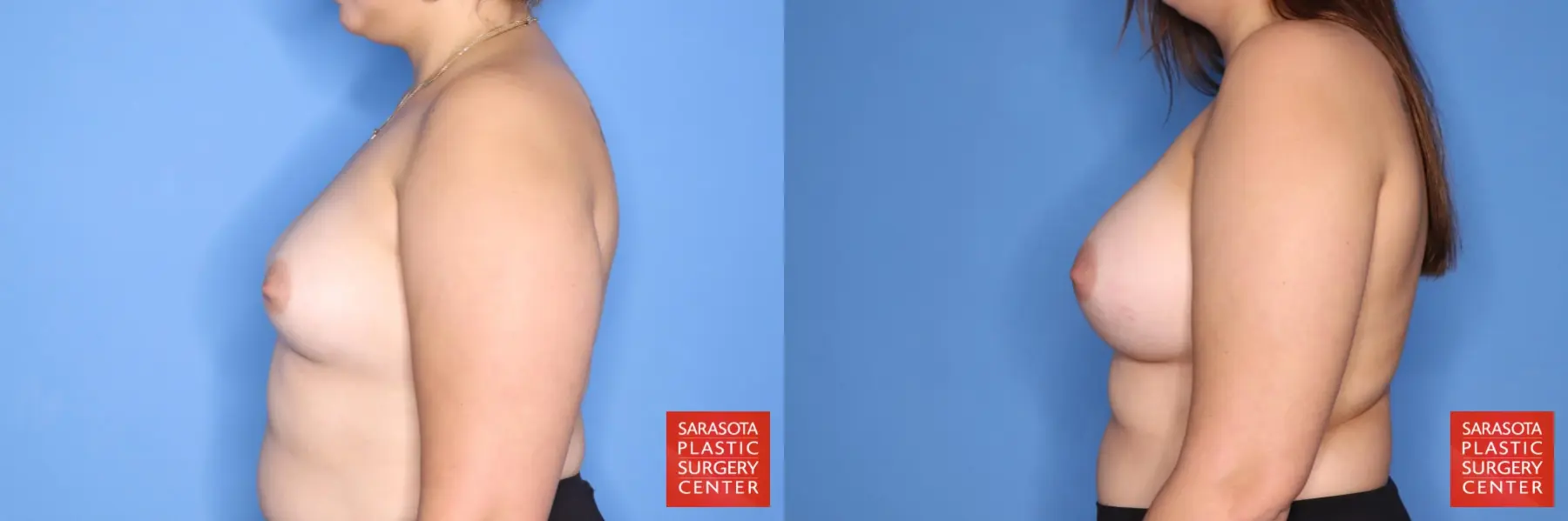 Breast Augmentation: Patient 200 - Before and After 3