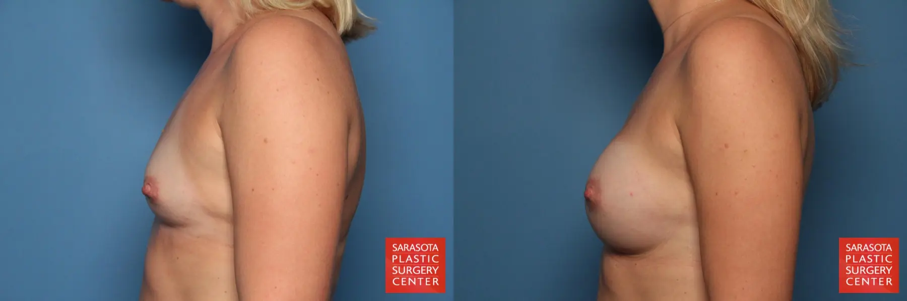 Breast Augmentation: Patient 55 - Before and After 3