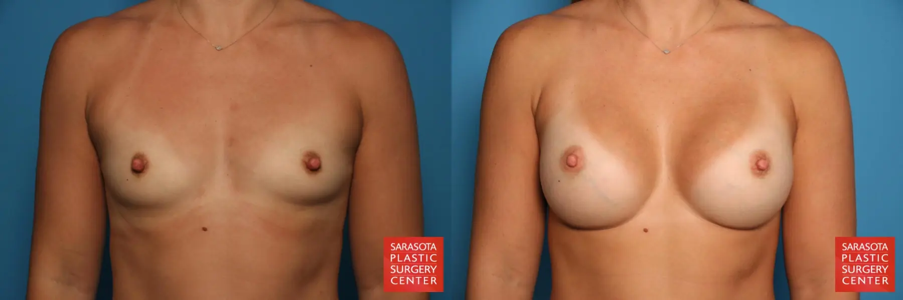 Breast Augmentation: Patient 5 - Before and After  