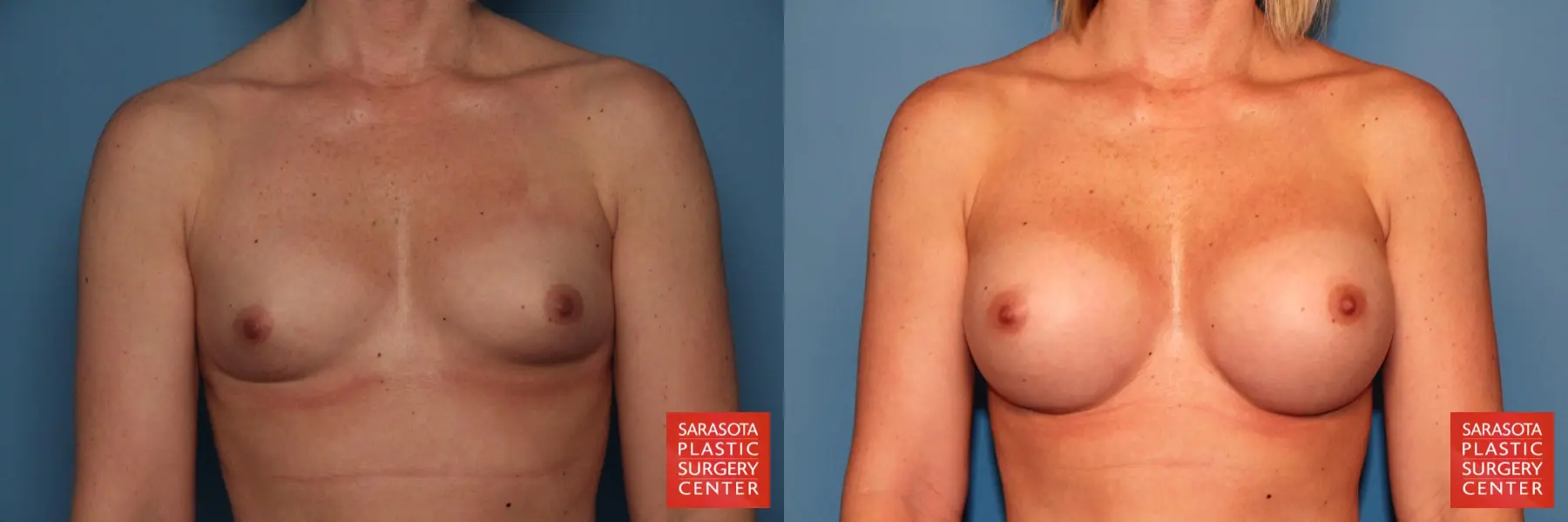 Breast Augmentation: Patient 16 - Before and After  