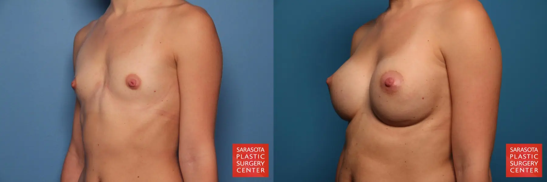 Breast Augmentation: Patient 69 - Before and After 2