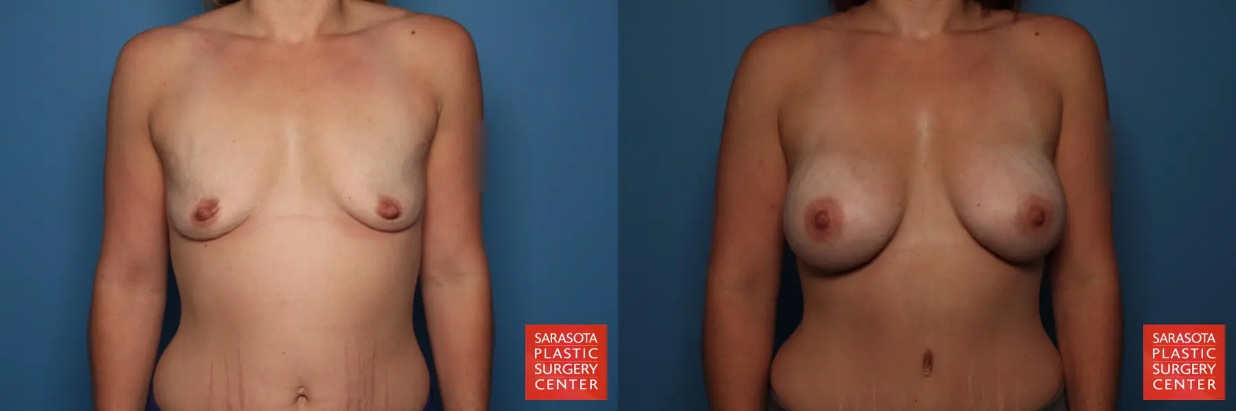 Breast Augmentation: Patient 166 - Before and After  