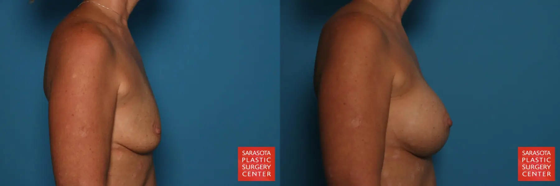 Breast Augmentation: Patient 169 - Before and After 3