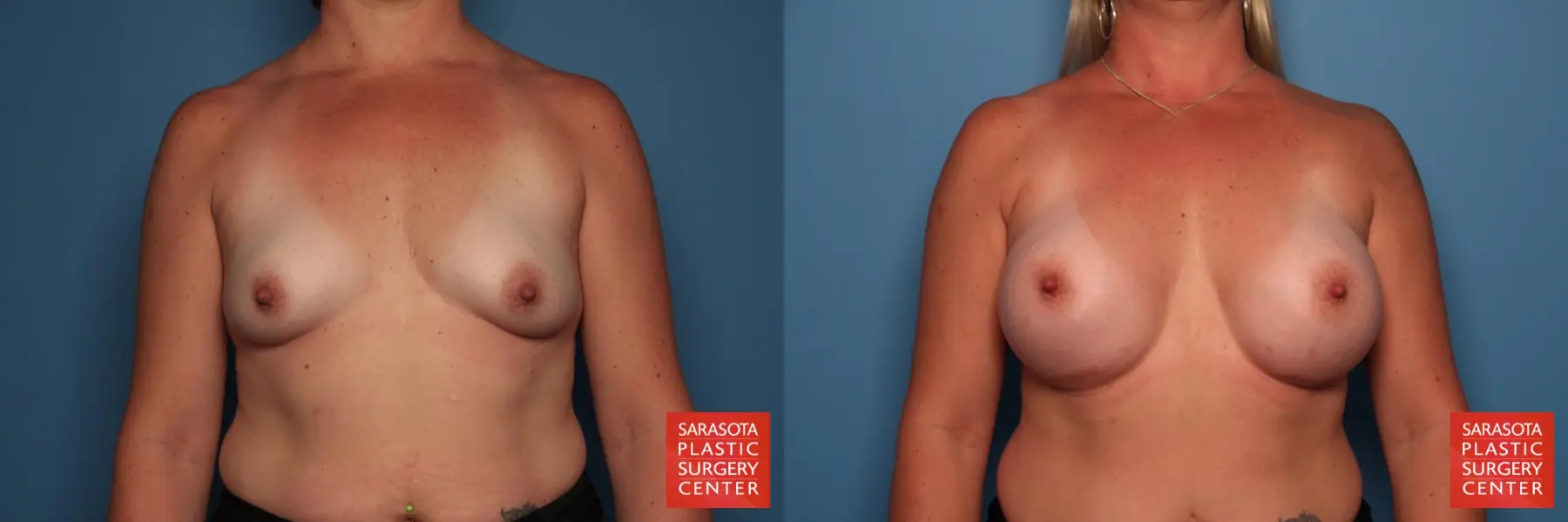 Breast Augmentation: Patient 131 - Before and After  