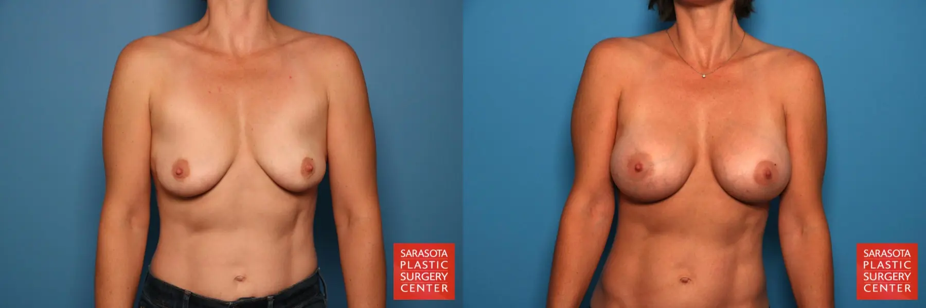 Breast Augmentation: Patient 146 - Before and After  