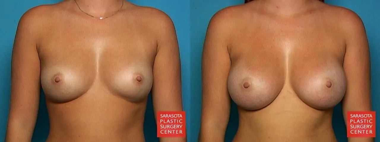 Breast Augmentation: Patient 24 - Before and After  