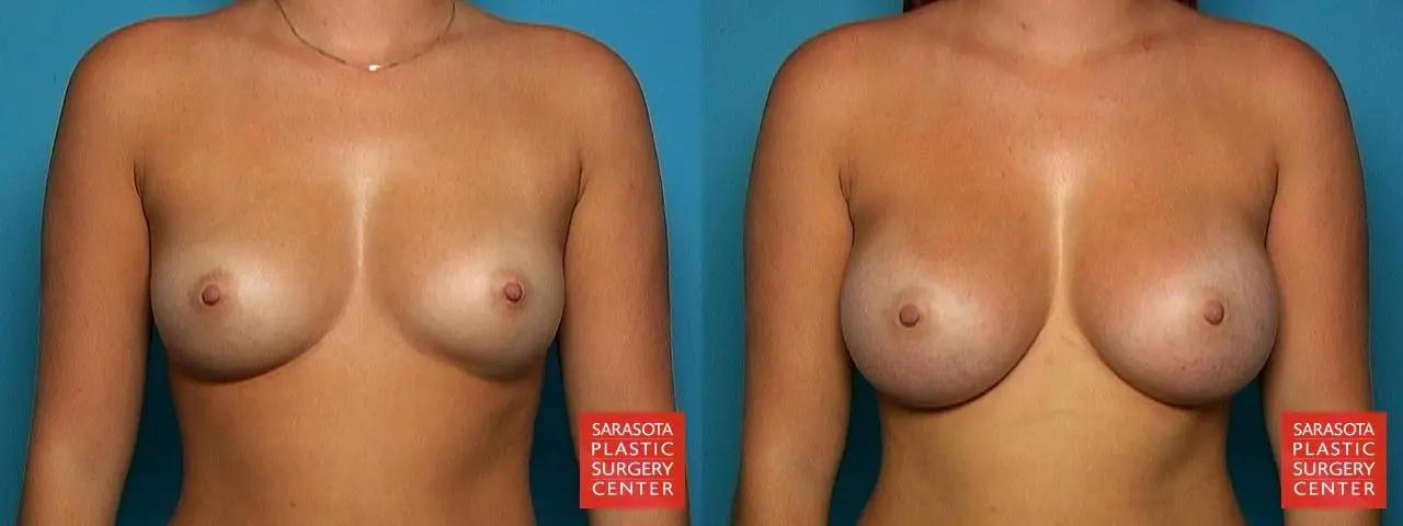 Breast Augmentation: Patient 10 - Before and After  