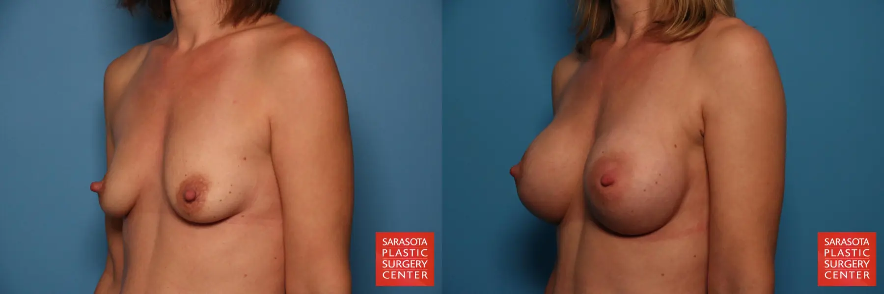 Breast Augmentation: Patient 147 - Before and After 2