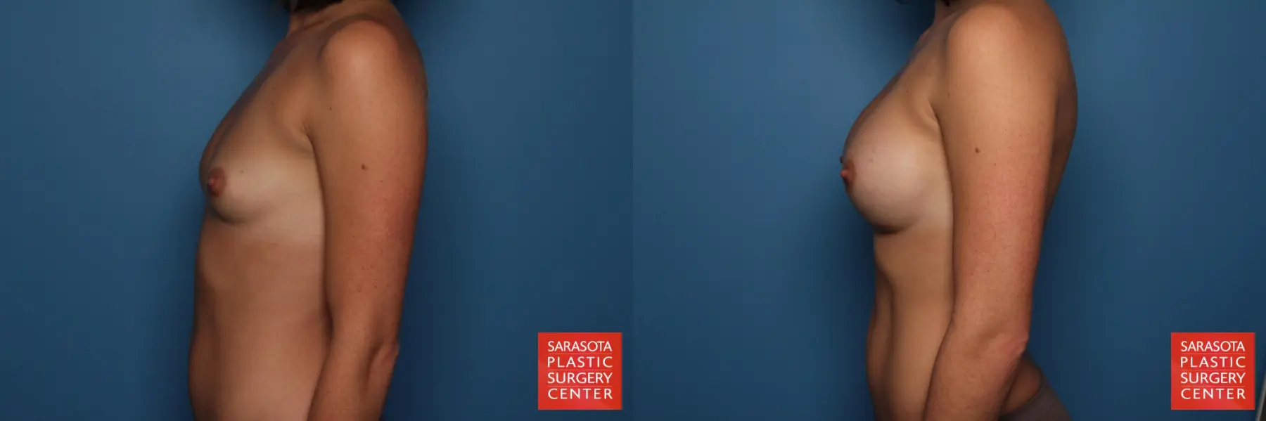 Breast Augmentation: Patient 29 - Before and After 3