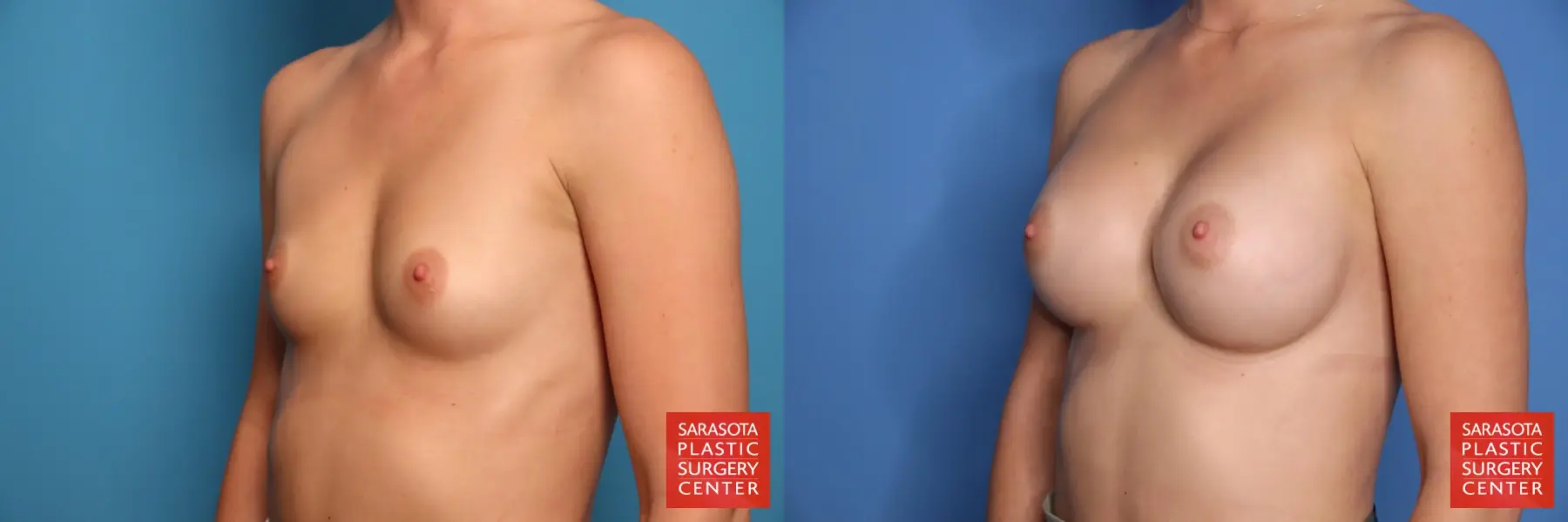 Breast Augmentation: Patient 208 - Before and After 2