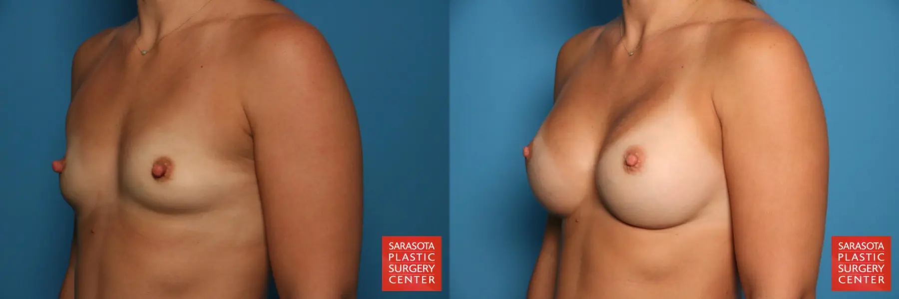 Breast Augmentation: Patient 5 - Before and After 2