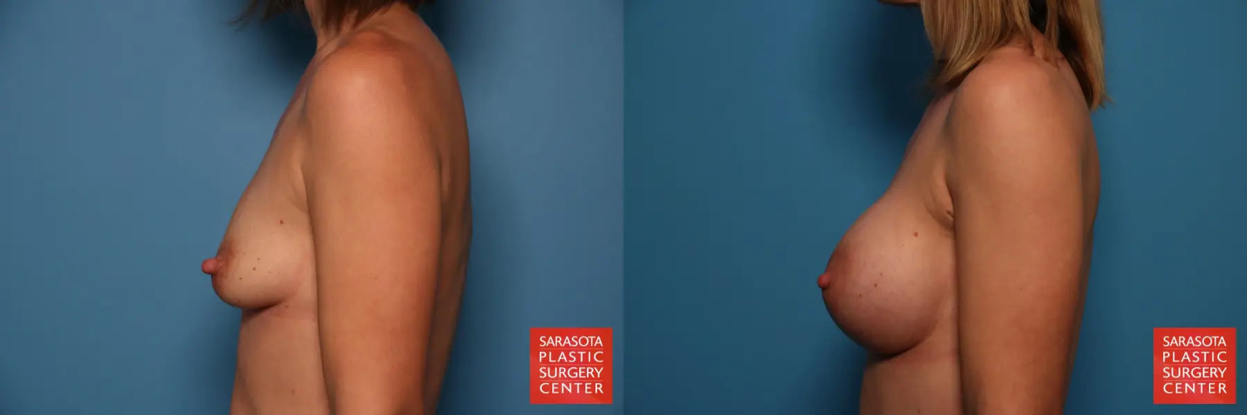 Breast Augmentation: Patient 147 - Before and After 3