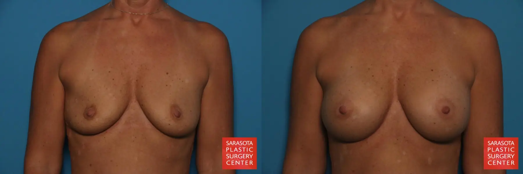 Breast Augmentation: Patient 169 - Before and After  