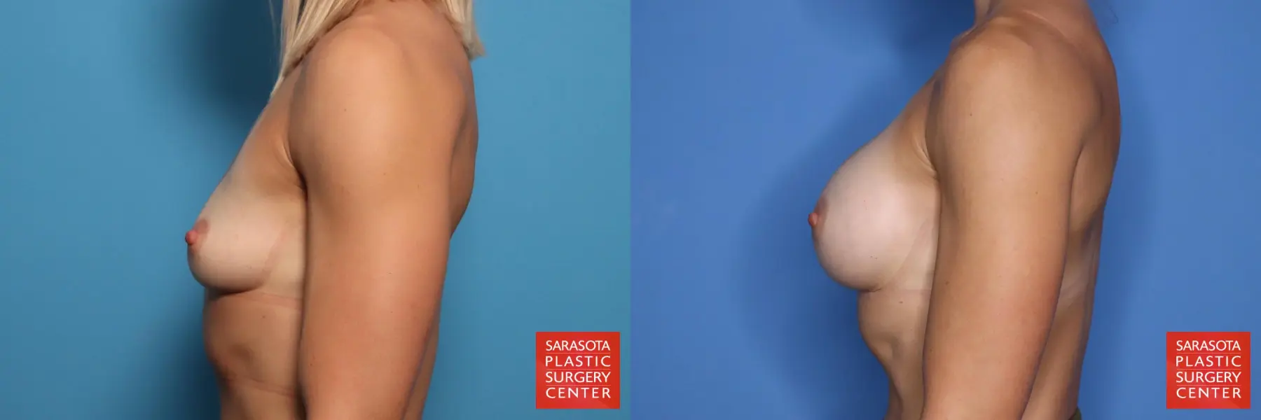 Breast Augmentation: Patient 175 - Before and After 3