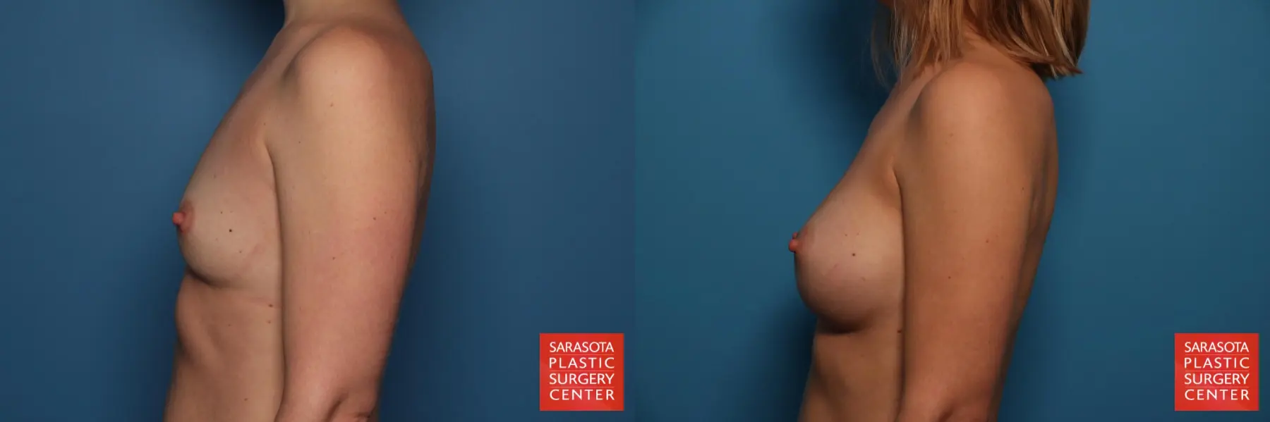 Breast Augmentation: Patient 75 - Before and After 3