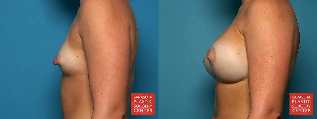 Breast Augmentation With Lift: Patient 18 - Before and After 3