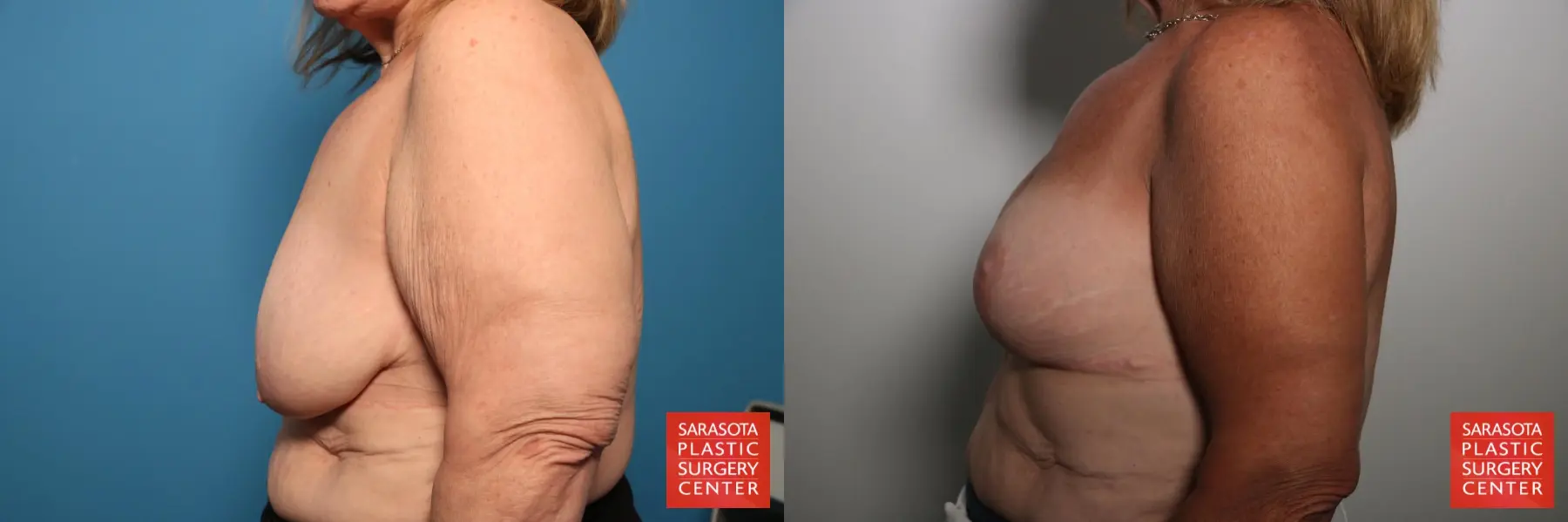 Breast Augmentation With Lift: Patient 83 - Before and After 3
