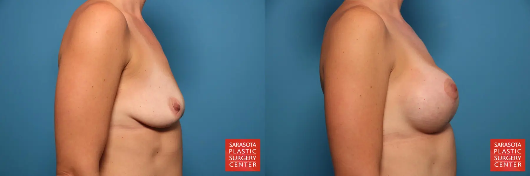 Breast Augmentation With Lift: Patient 59 - Before and After 3