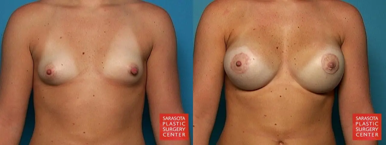 Breast Augmentation With Lift: Patient 18 - Before and After 1