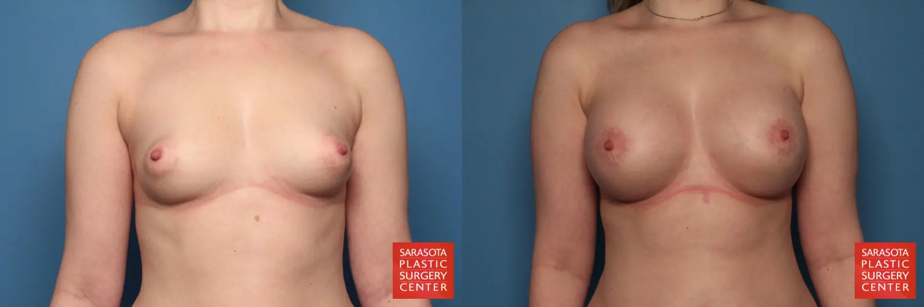 Breast Augmentation With Lift: Patient 15 - Before and After  
