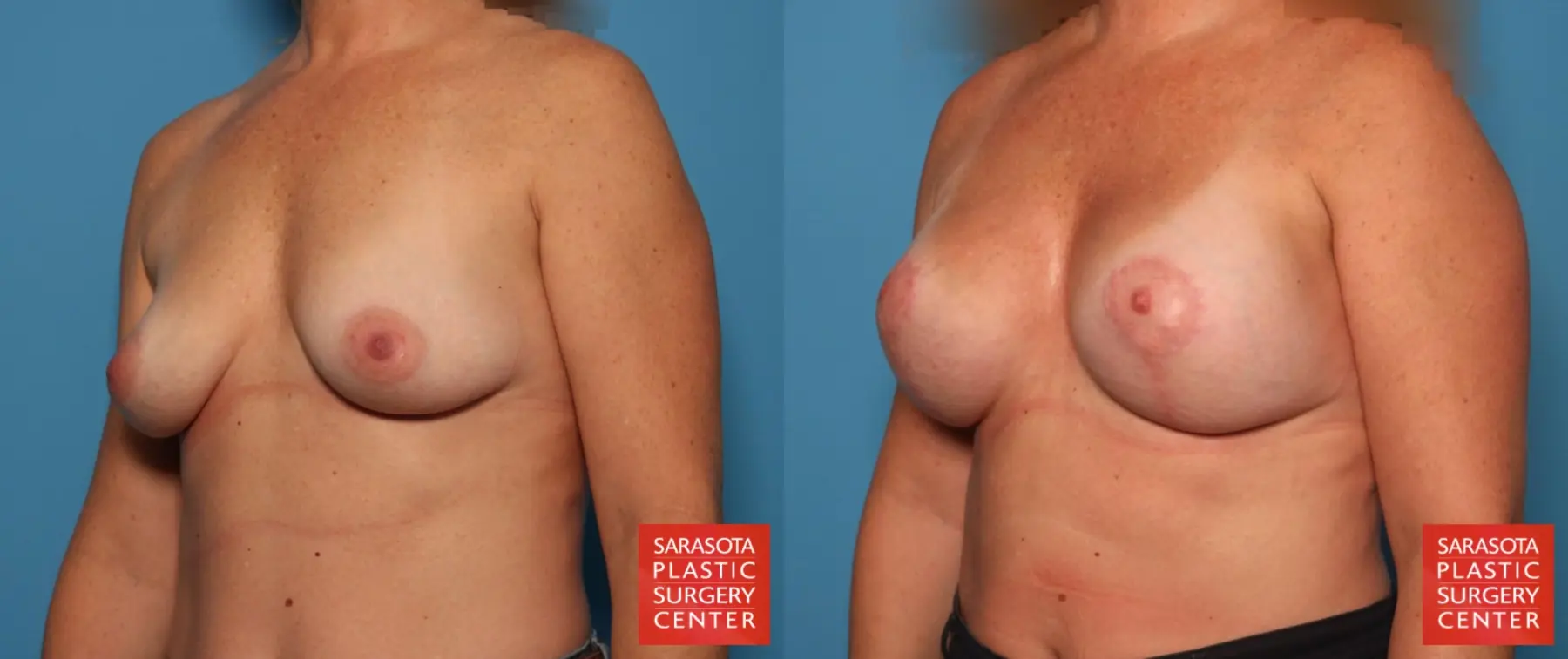 Breast Augmentation With Lift: Patient 80 - Before and After 2