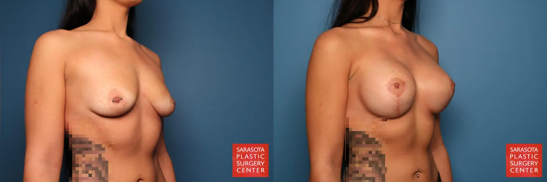 Breast Augmentation With Lift: Patient 8 - Before and After 4