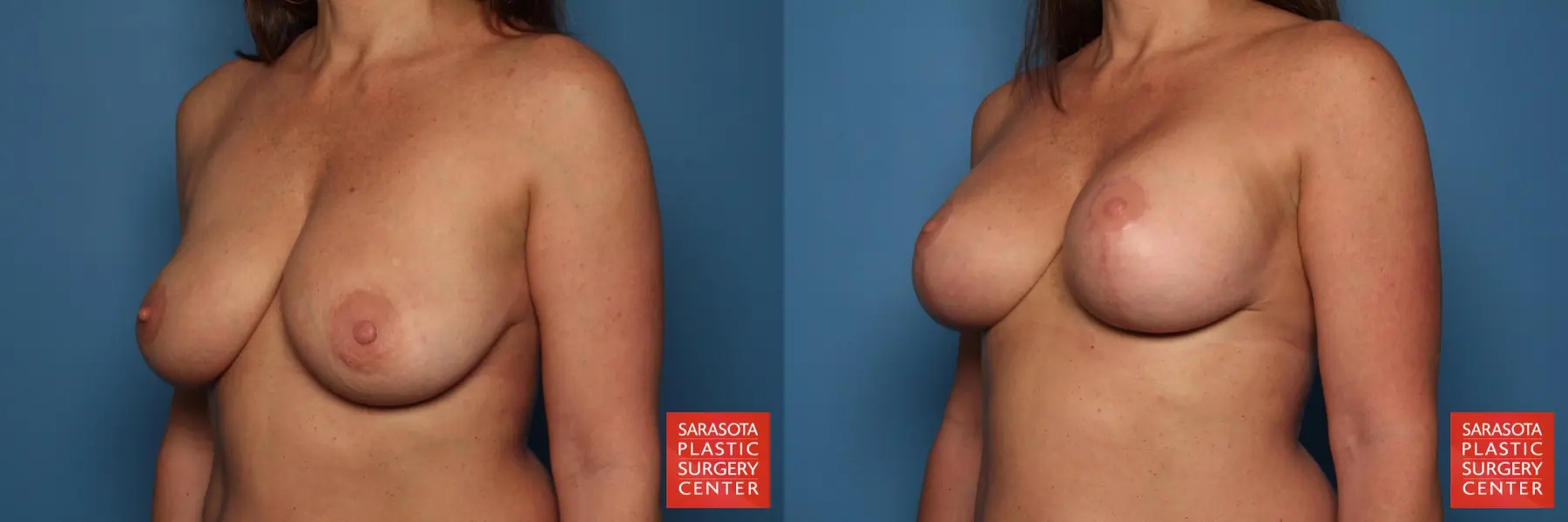 Breast Augmentation With Lift: Patient 38 - Before and After 2