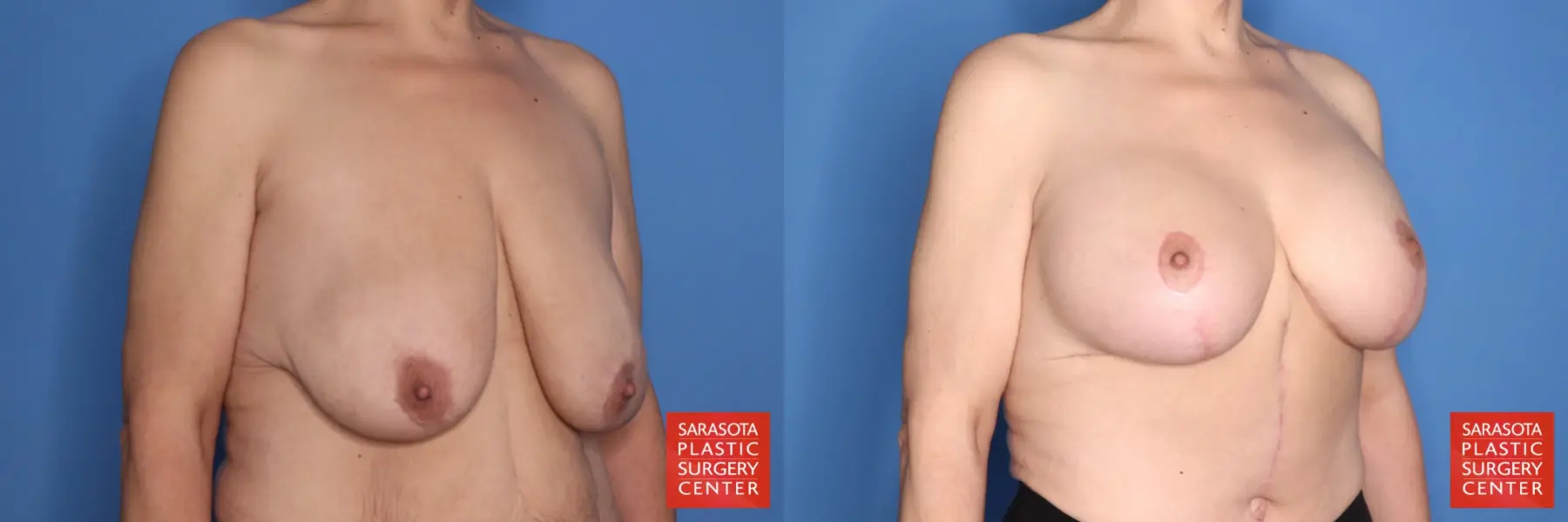 Breast Augmentation With Lift: Patient 97 - Before and After 2