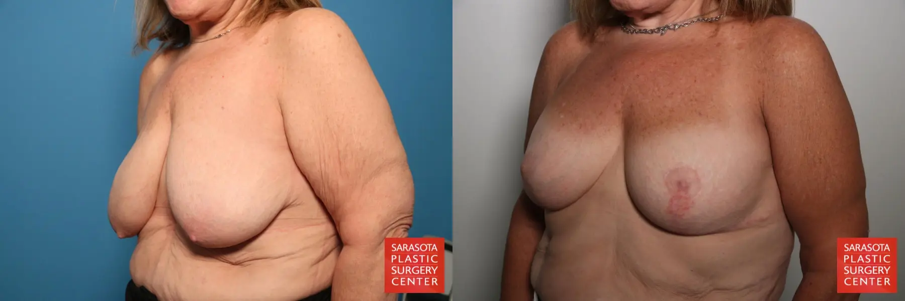 Breast Augmentation With Lift: Patient 83 - Before and After 2