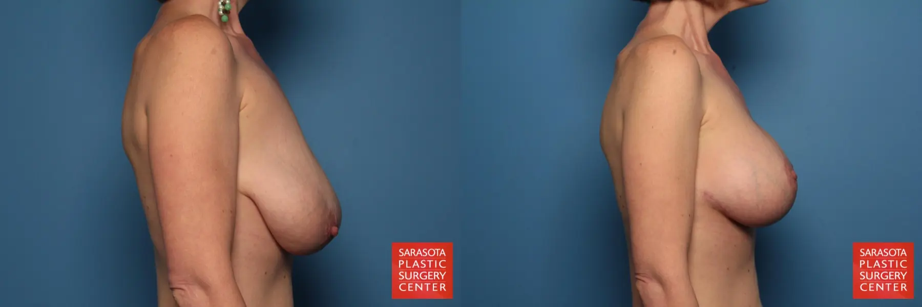 Breast Augmentation With Lift: Patient 10 - Before and After 3