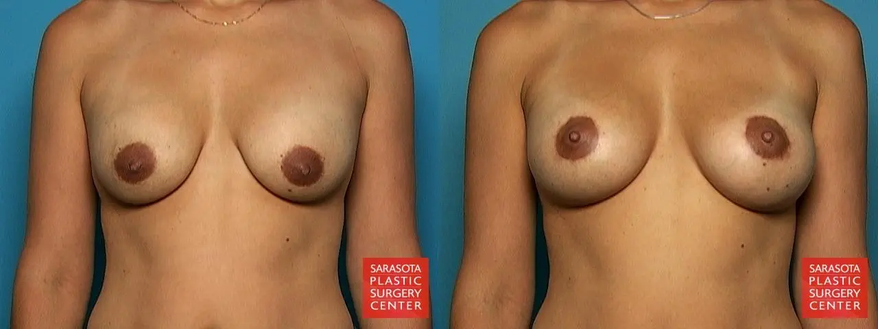 Breast Augmentation With Lift: Patient 24 - Before and After  