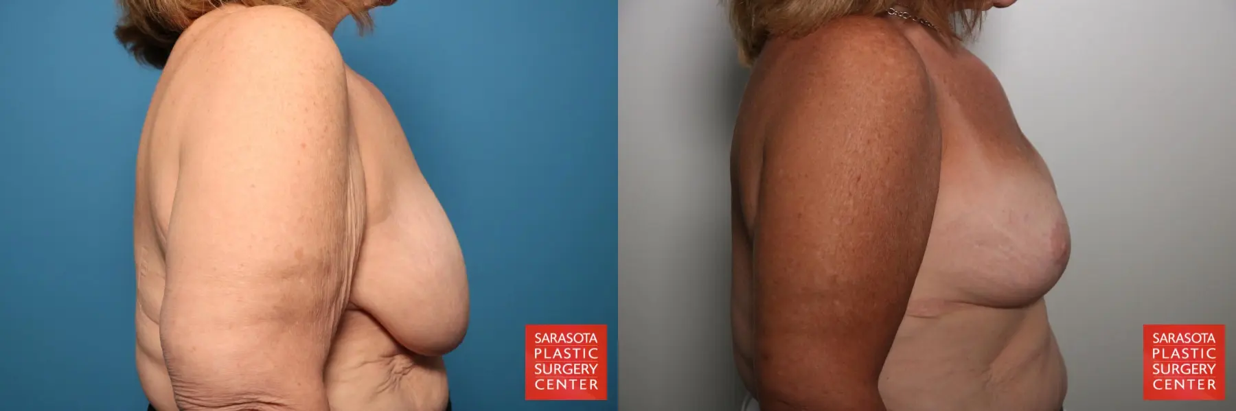 Breast Augmentation With Lift: Patient 83 - Before and After 5