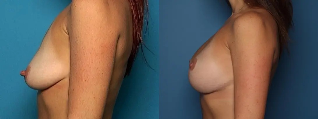 Breast Augmentation With Lift: Patient 32 - Before and After 3