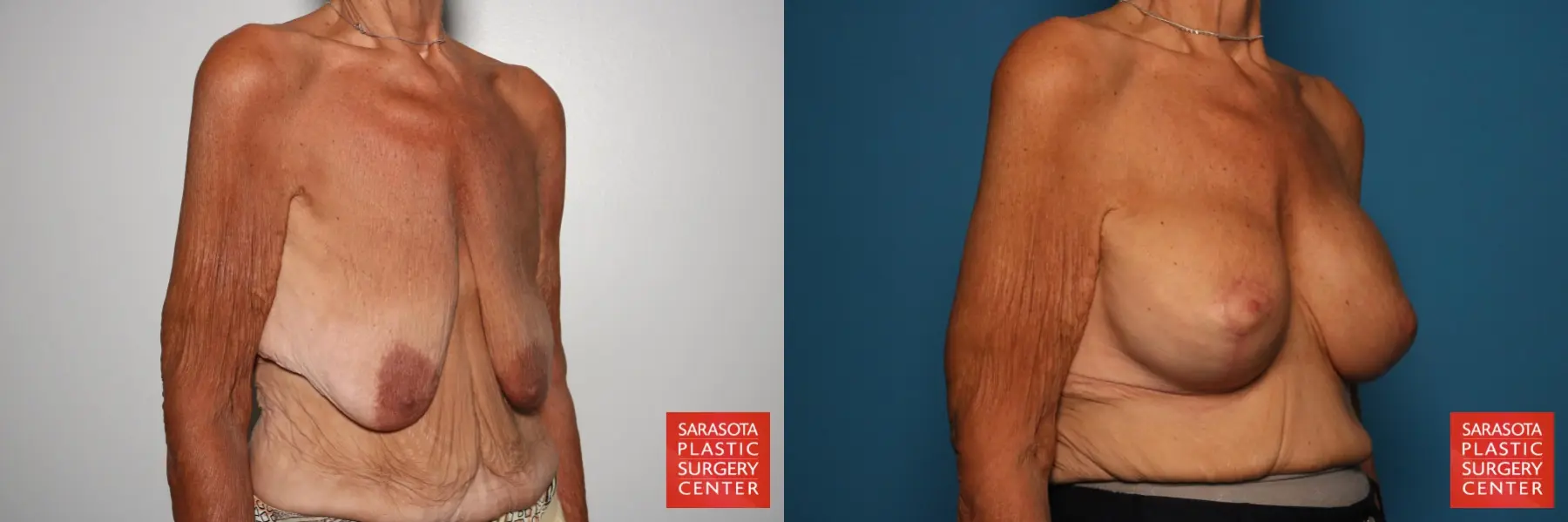 Breast Augmentation With Lift: Patient 88 - Before and After 2
