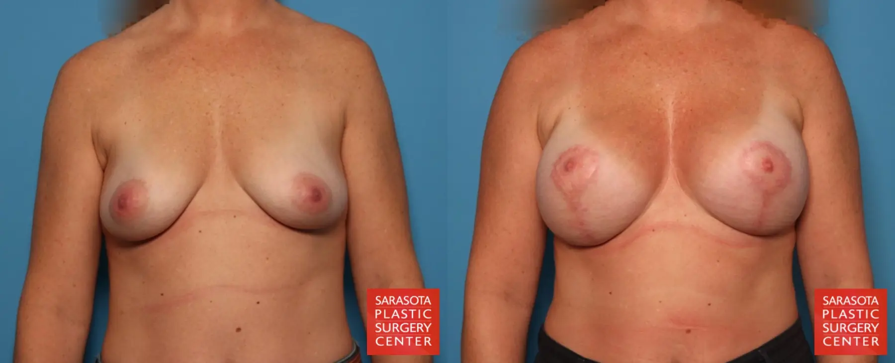 Breast Augmentation With Lift: Patient 80 - Before and After 1