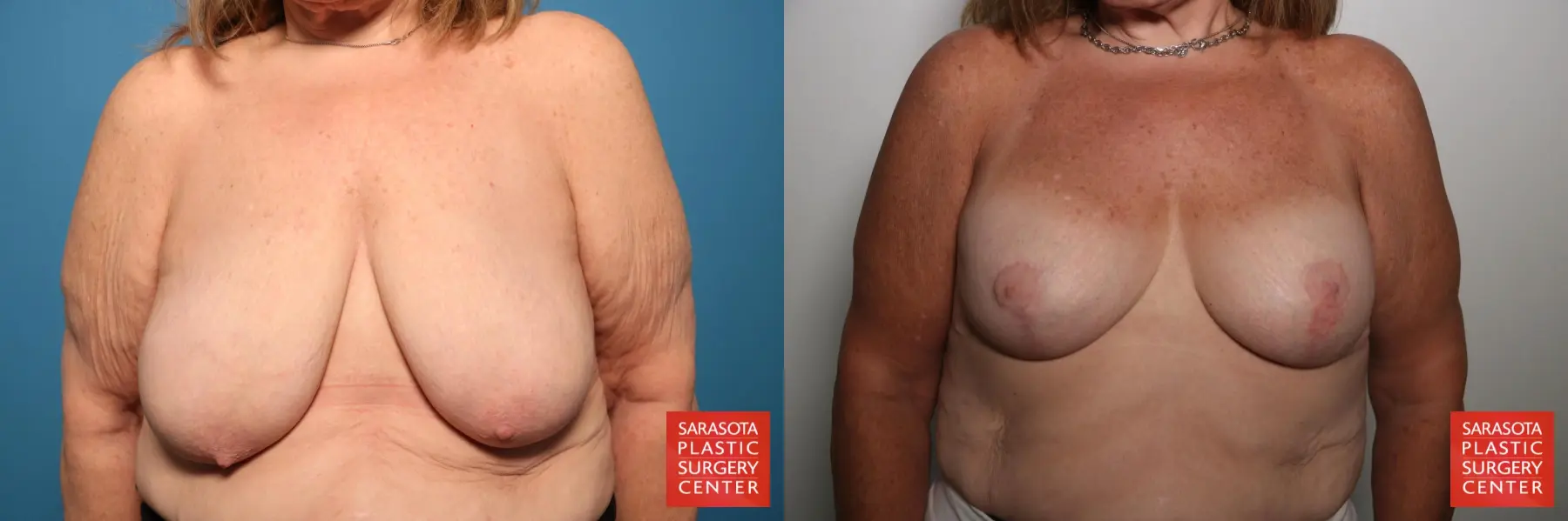 Breast Augmentation With Lift: Patient 83 - Before and After 1
