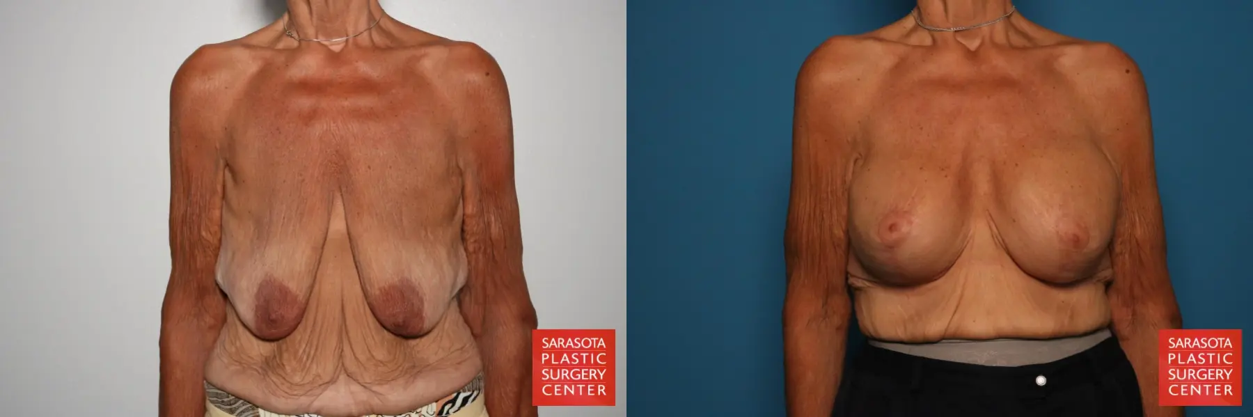 Breast Augmentation With Lift: Patient 88 - Before and After 1