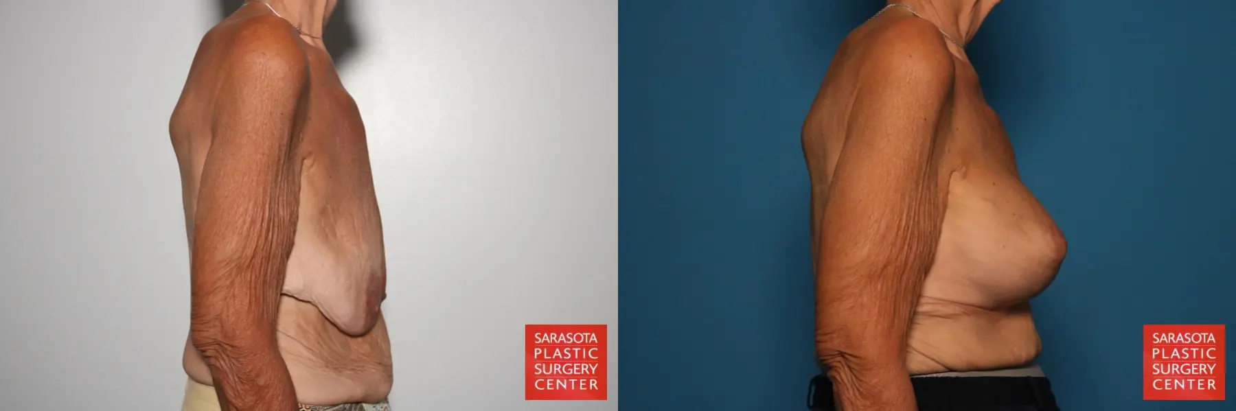 Breast Augmentation With Lift: Patient 88 - Before and After 3