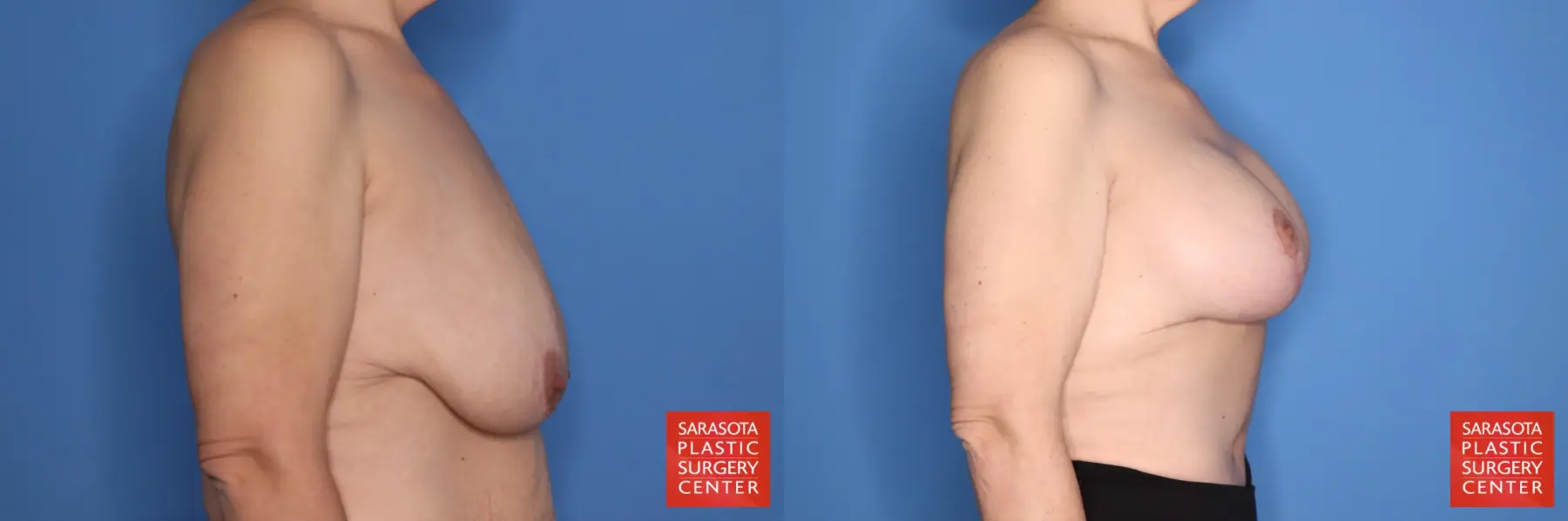 Breast Augmentation With Lift: Patient 97 - Before and After 3