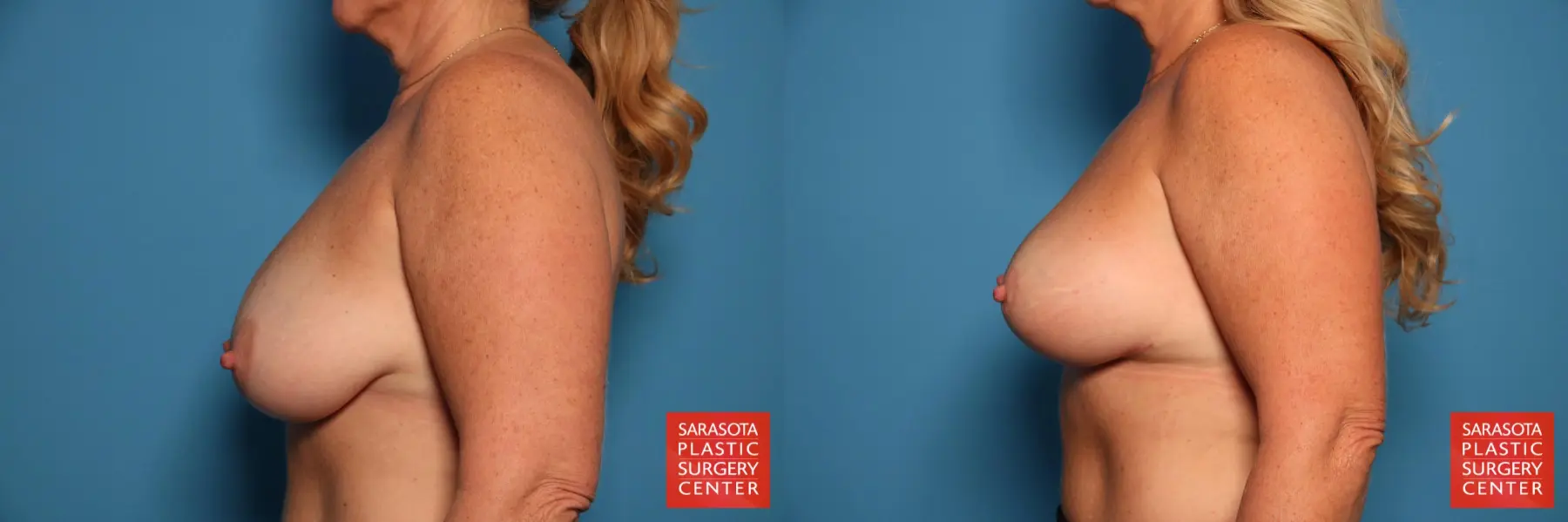 Breast Augmentation With Lift: Patient 65 - Before and After 3