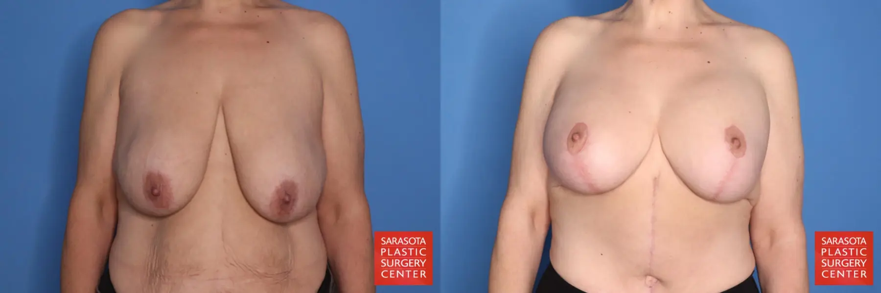 Breast Augmentation With Lift: Patient 97 - Before and After 1