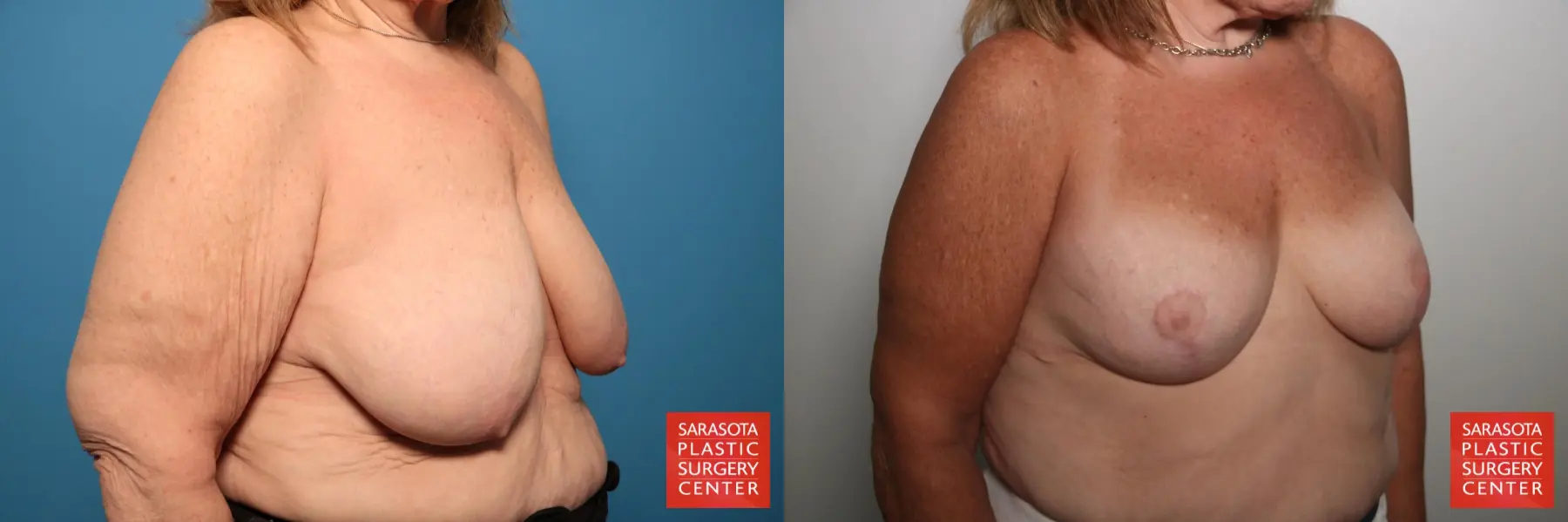 Breast Augmentation With Lift: Patient 83 - Before and After 4