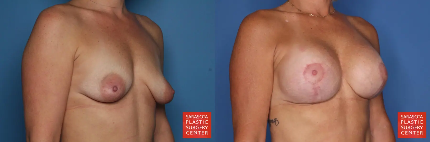 Breast Augmentation With Mesh : Patient 1 - Before and After 4